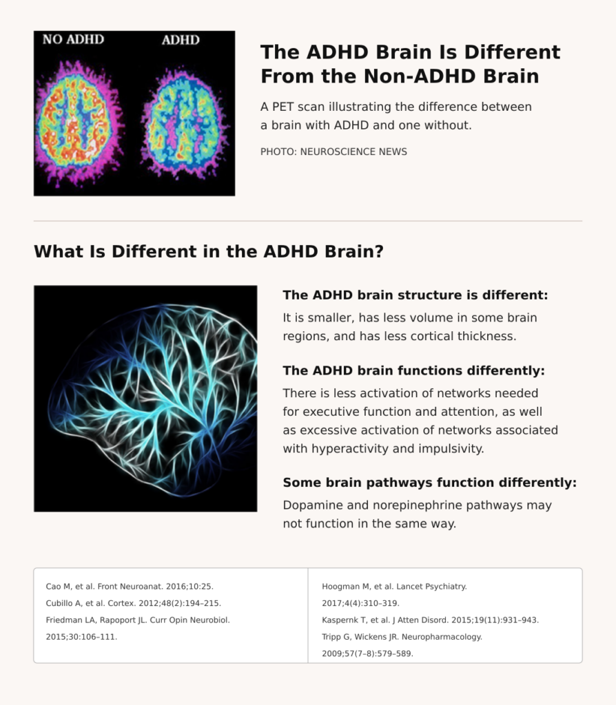 Infographic comparing PET brain scans with and without ADHD and explaining differences in brain structure, function, and dopamine and norepinephrine pathways.